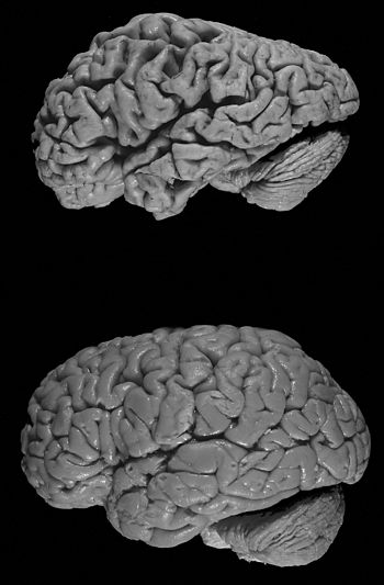 Healthy brain (bottom) versus brain of a donor... Healthy brain (bottom) versus brain of a donor...