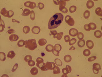 Blood smear of a patient with Iron deficiency ...