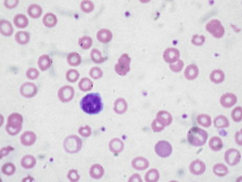 English: Peripheral blood film of a patient wi...