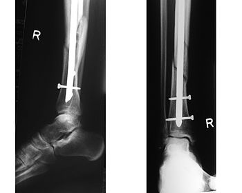 X-ray showing the distal portion of a fracture...