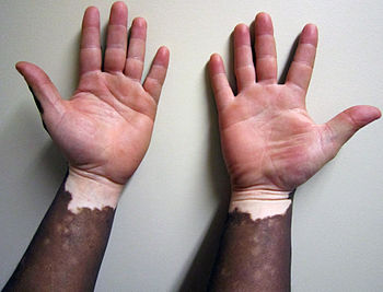 English: Vitiligo